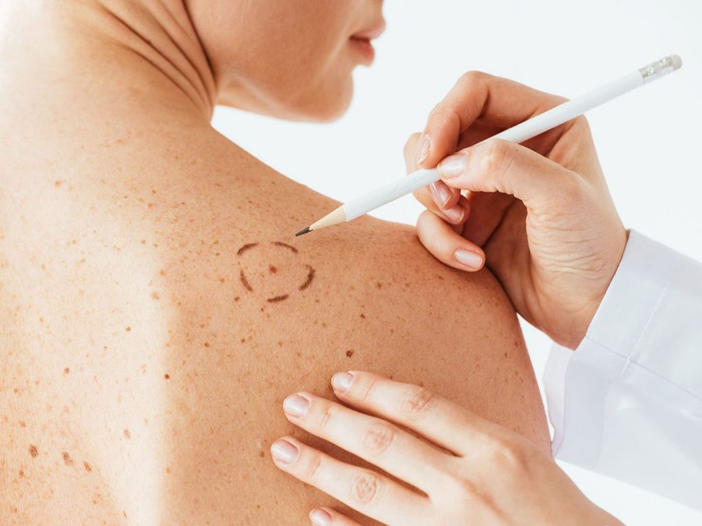 Tratamiento del Cáncer de piel