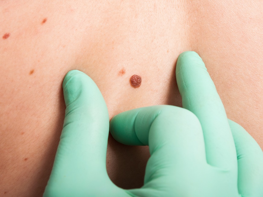 Síntomas del Cáncer de piel