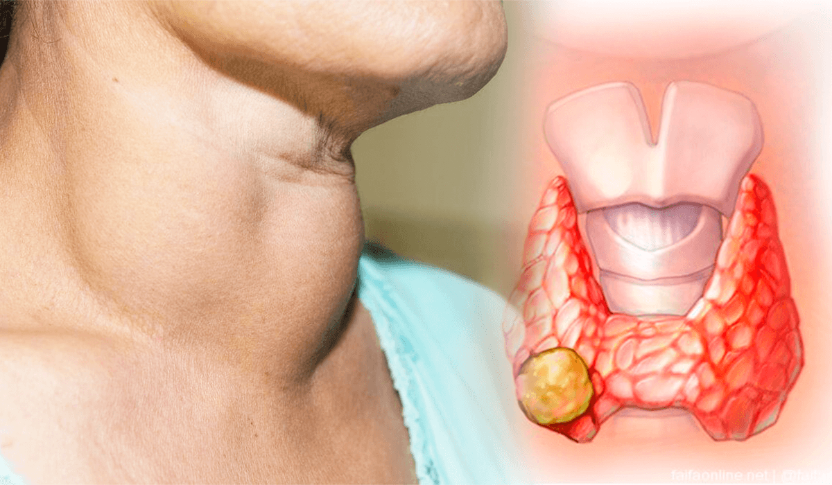 Sintomas del Cáncer de tiroides